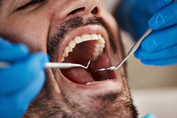 Best Lost Filling or Crown Replacement in Edgard, LA
